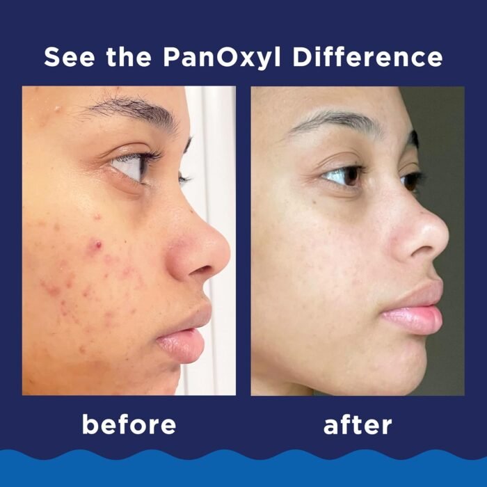 PanOxyl Acne Foaming Wash Benzoyl Peroxide 10% Maximum Strength Antimicrobial, 5.5 Oz - Image 5